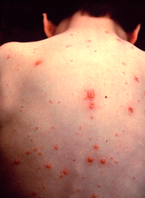 Pediatrician warns of local chickenpox outbreak - The Andalusia Star ...